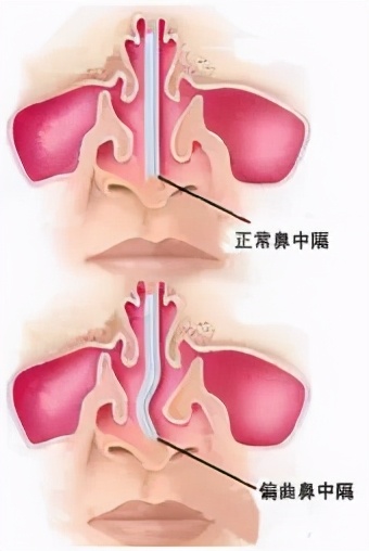 鼻塞一直打喷嚏是鼻咽癌吗,鼻塞流涕有喷嚏打不出来