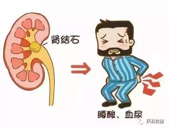 肾结石是中医治疗还是西医治疗好,肾结石中医治疗好还是西医治疗好