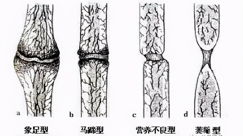 骨折术后为什么总是不舒服,骨折术后为什么有的人不愈合