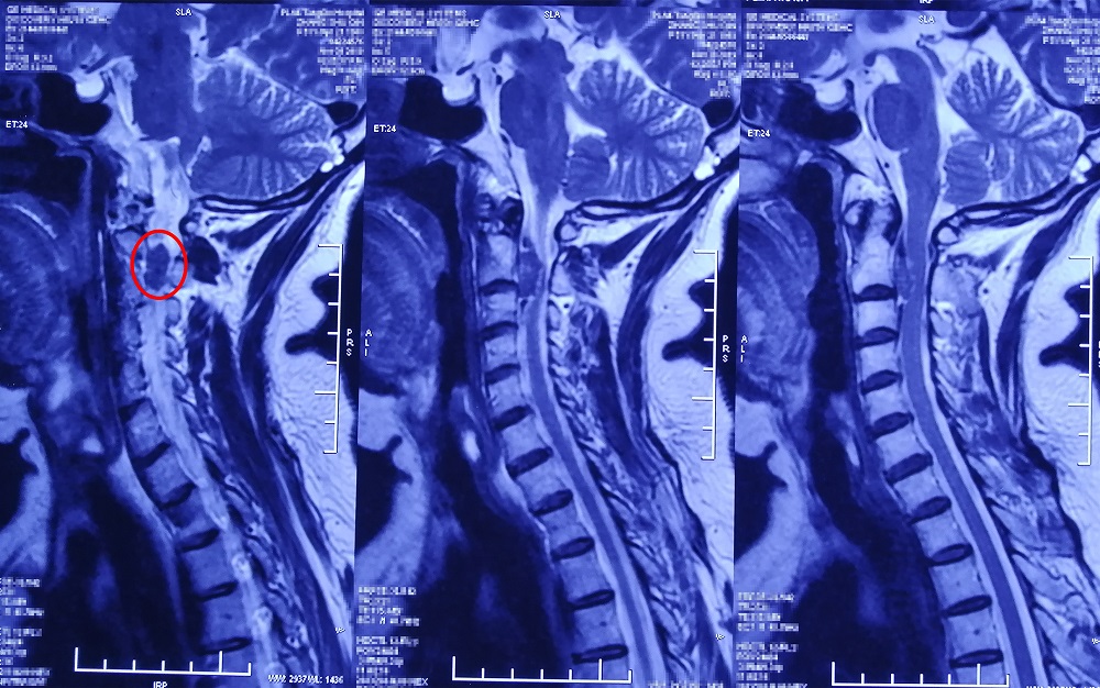 间歇性双手麻木是什么原因和征兆,双手指持续性发麻是什么原因