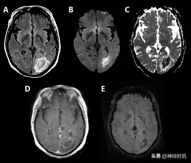 脑卒中的快速识别ppt,脑卒中神经影像学实例解析