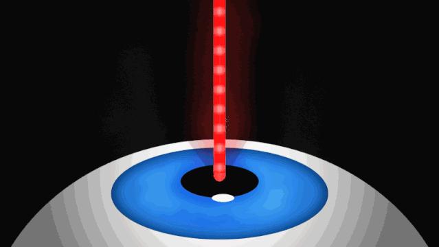 icl近视手术经验分享,icl近视手术成功经验