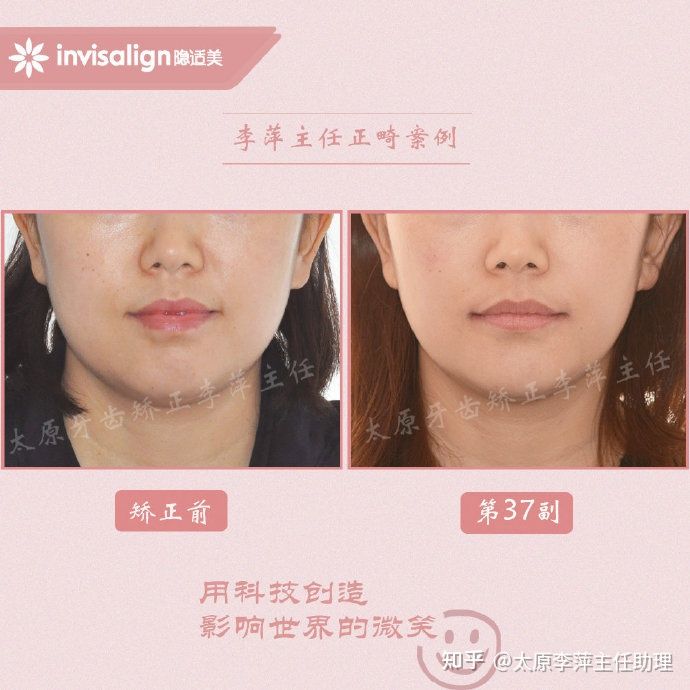 太原牙齿矫正靠谱吗,太原成人隐形牙套牙齿不齐