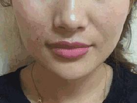 医生谈线雕面部提升危害,线雕提升能做吗