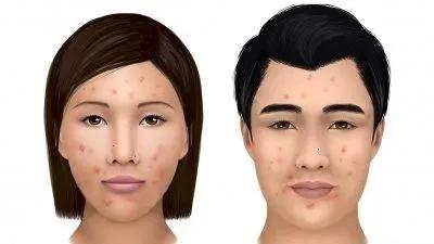 皮肤爆痘急救的最佳方法,脸上爆痘饮食怎么控制