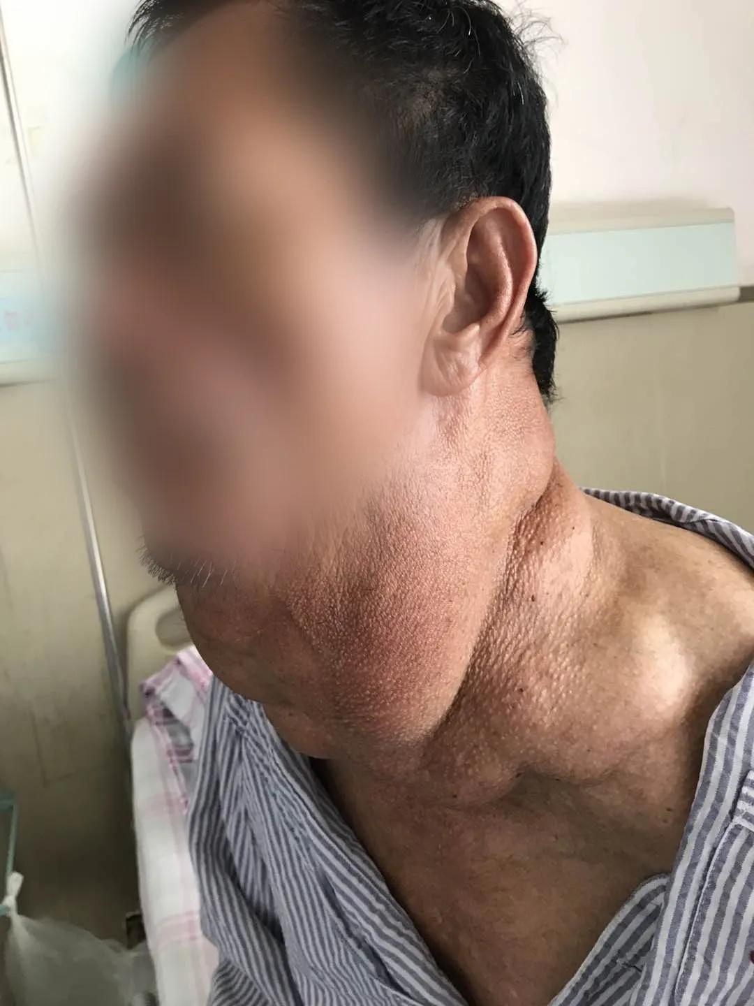 喝白酒长出河马脖,62岁大叔喝出河马脖