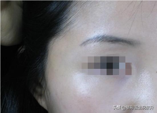 用自体脂肪填充有什么副作用,用自体脂肪填充太阳穴