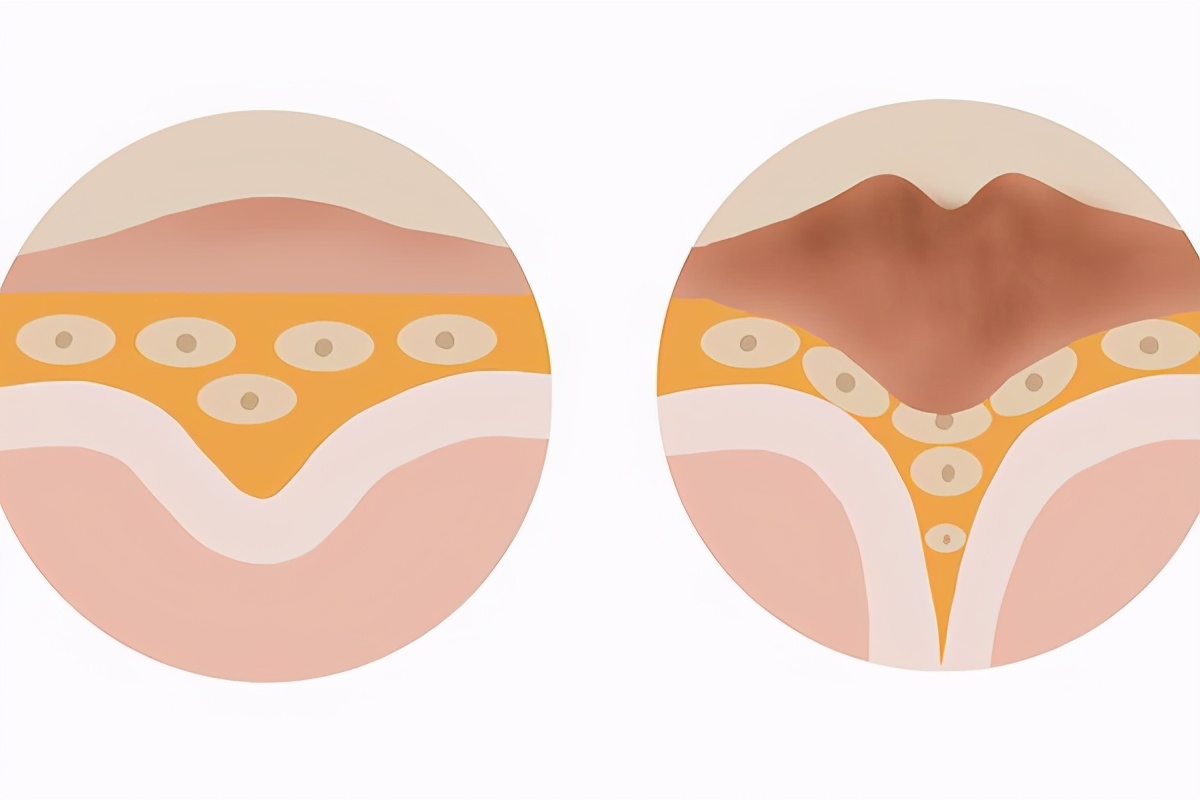 鸡眼怎么回事,鸡眼是怎么回事用什么药治疗