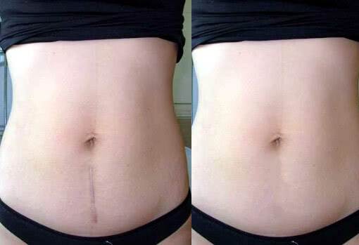 剖腹产的疤痕跟什么疤痕像,女人剖腹产疤痕十年后还有疤痕吗