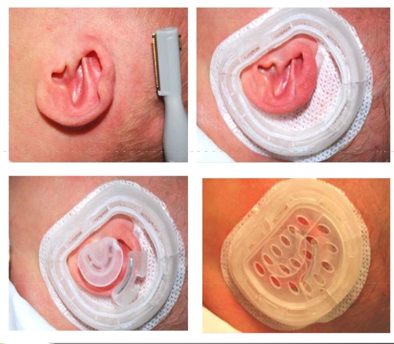 余文林耳再造失败案例,余文林耳畸形手术