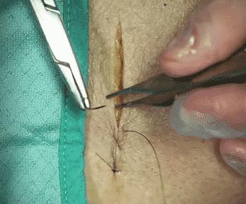 常用的手术缝合方法图,临床常见常用伤口缝合方法