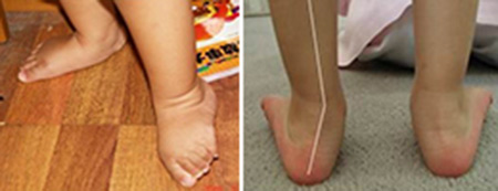 3岁足外翻到底要不要干预,儿童足外翻要早干预吗