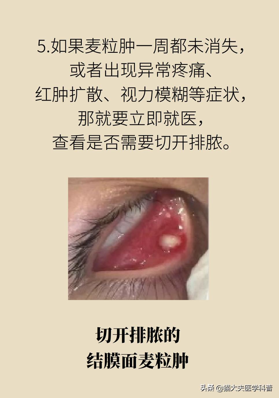 爱长针眼怎么回事,爱长针眼咋整