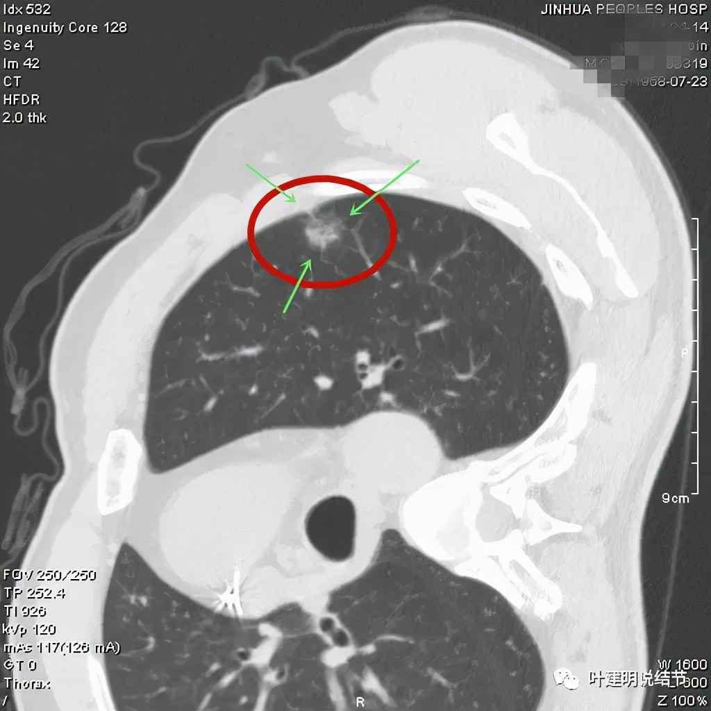 从活检怎么看是非小细胞癌,从病例谈辨证论治