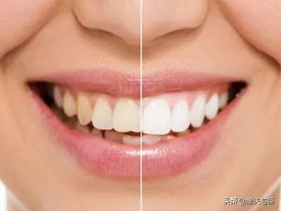 小苏打去黄牙小妙方,小苏打可以美白护肤吗