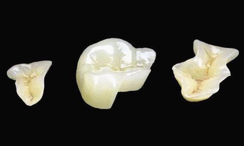 补牙太贵了五百块,补牙有300多和200多的差别在哪里