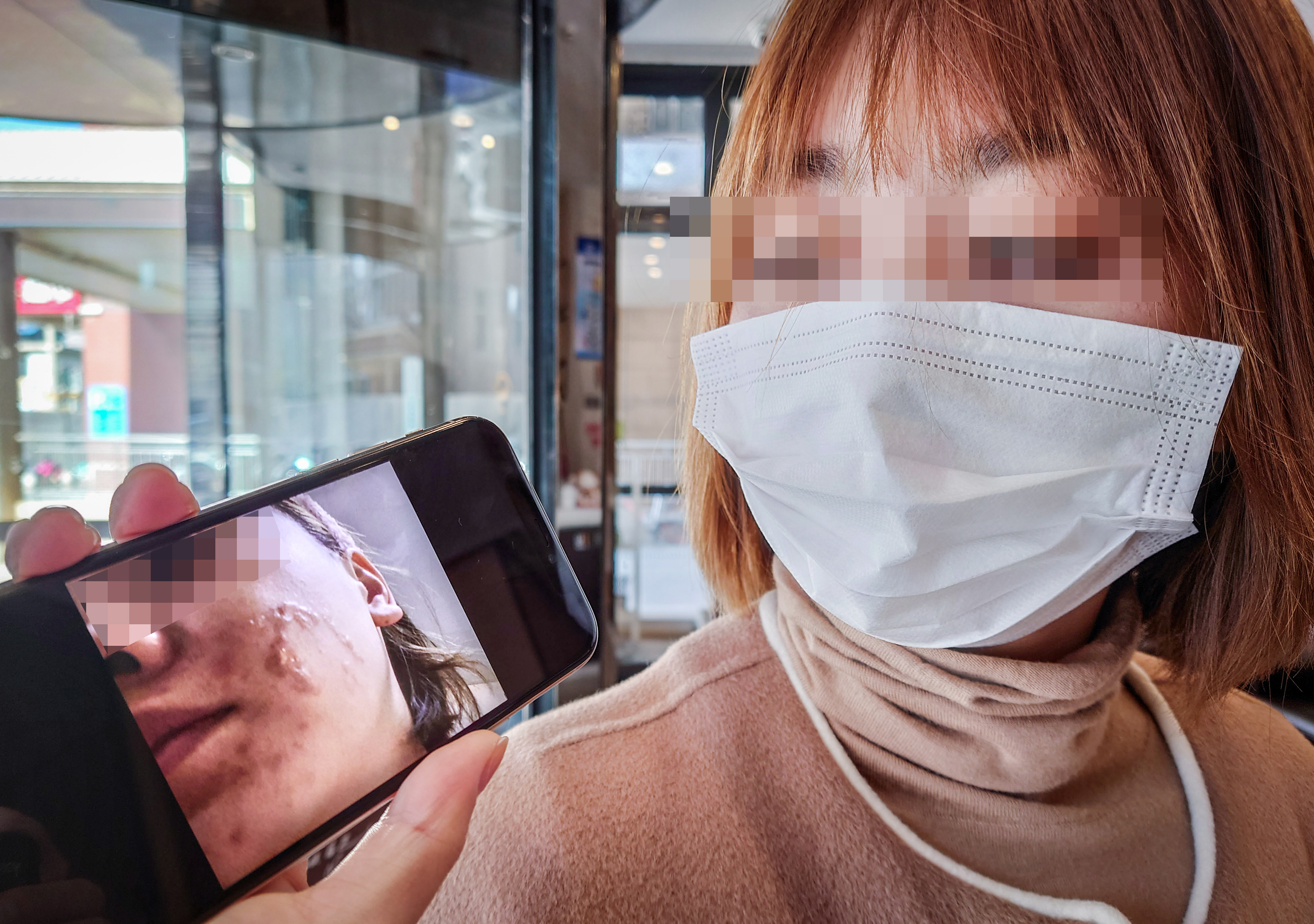 沈阳女子在“伊美尔”做医美后脸上烫出水疱，花近3万却换回二度烫伤