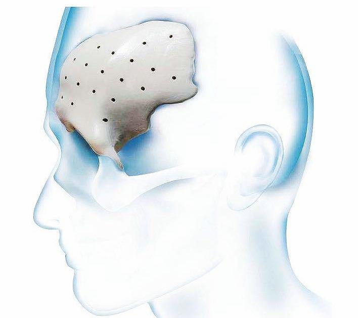 拯救大脑危机,颅骨缺损不补对大脑有影响吗