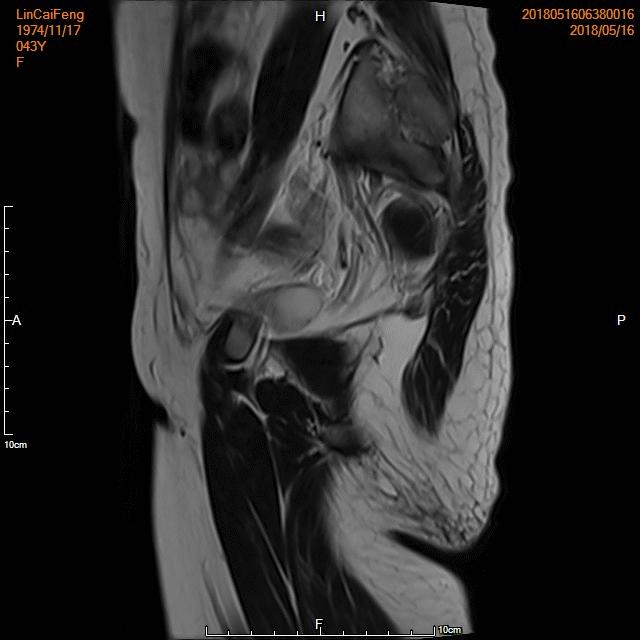 子宫腺肌症介入栓塞全国哪里好,子宫腺肌症介入栓塞治疗报销吗