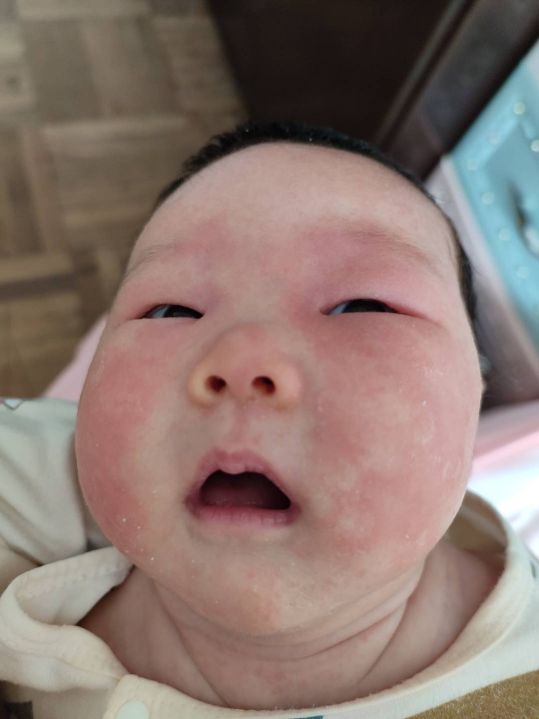 宝宝大作战8-9,宝宝湿疹大作战