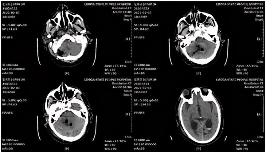 基层医院神经外科微创脑出血前景,高血压脑出血新突破
