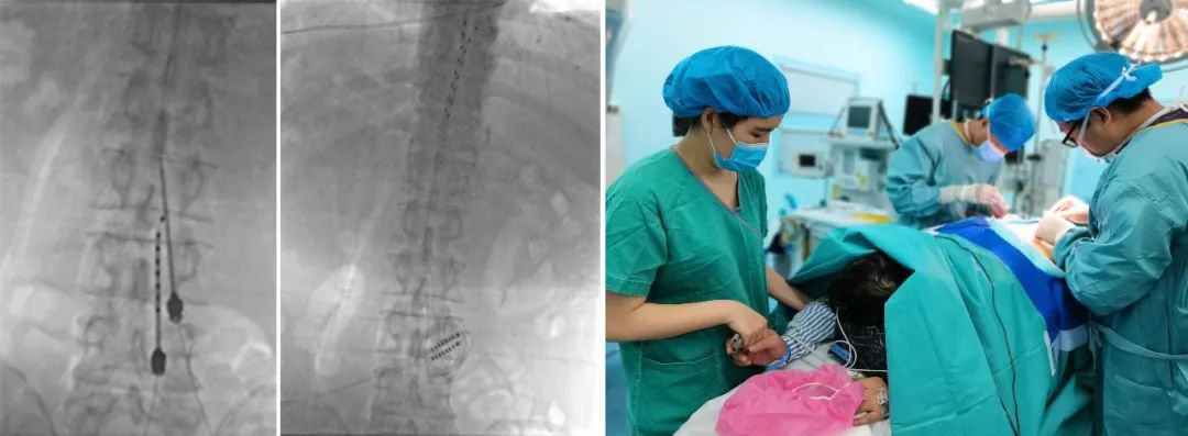 坐骨神经痛是糖尿病引起的吗,被糖尿病并发症吓到