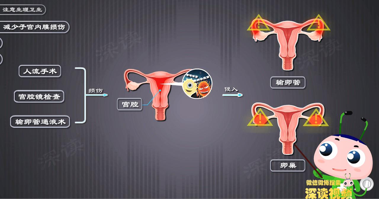 妇科附件炎最佳治疗方法,人流后附件炎是怎么引起的