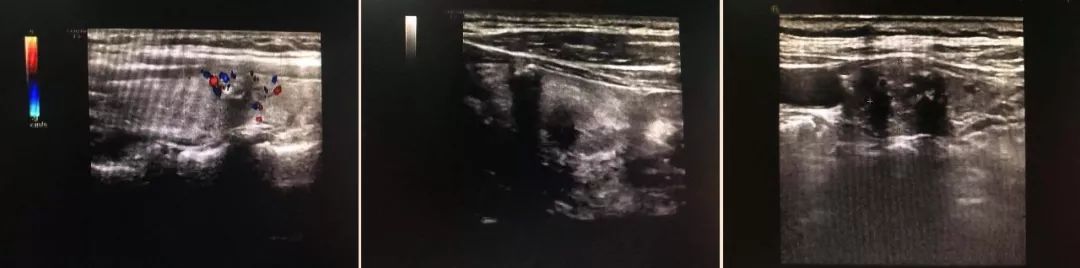 中西医对甲状腺癌病机、诊断与治疗方法解析