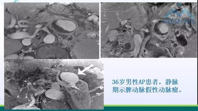 急性胰腺炎的护理措施,急性胰腺炎影像与临床