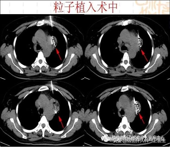 四川肿瘤医院碘125粒子植入术,肿瘤碘125粒子植入术图片