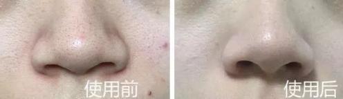 吸黑头神器去粉刺角质收缩毛孔,皮肤清洁收缩毛孔黑头角质