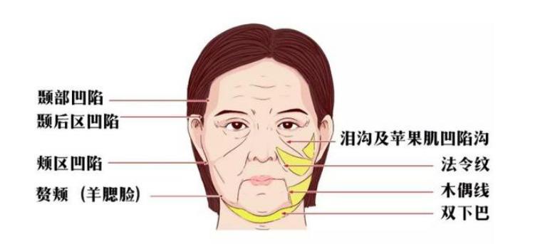 泪沟自体脂肪填充永久,自体脂肪填充太阳穴可以永久吗