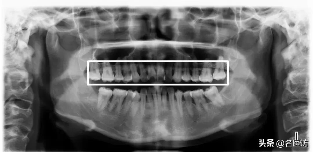 矫正科普|美人在骨不在皮，从神秘的牙片看牙齿和侧貌颜值