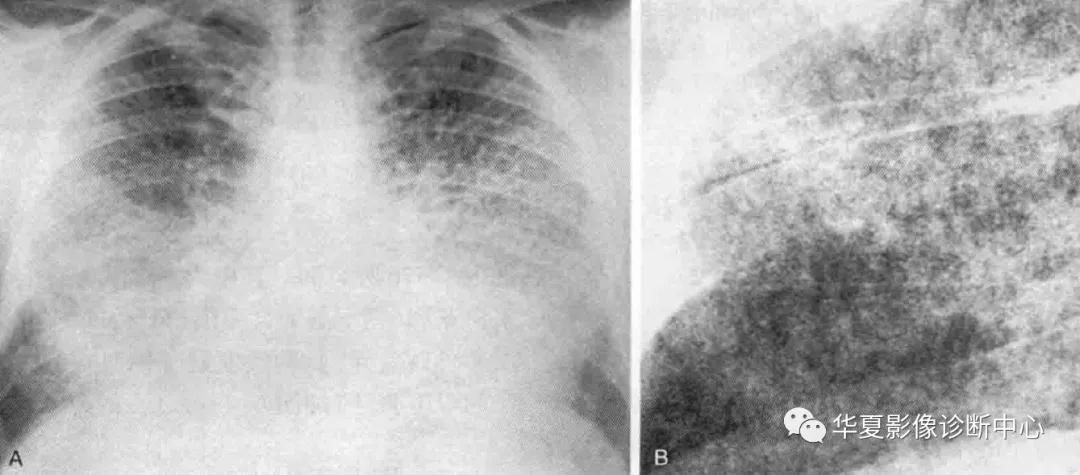 肺部代谢周期是多少天,肺部高代谢病变