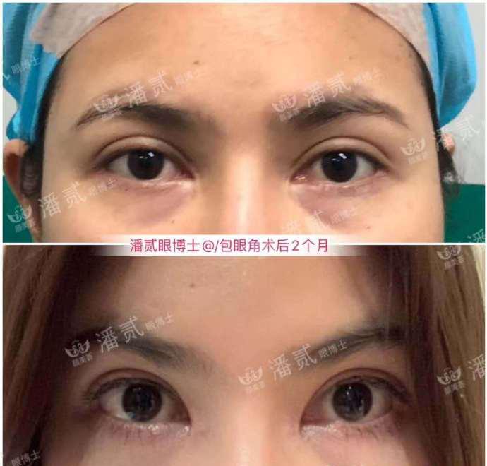 双眼皮改单眼皮案例,扇形双眼皮改平行双眼皮多少钱