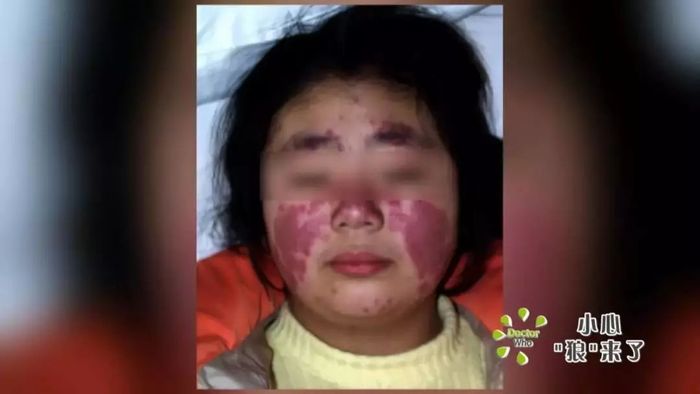 红斑狼疮做干细胞移植多少钱,干细胞治疗系统性红斑狼疮