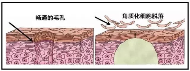 角质层是什么哪些人需要去角质层,角质层比较薄需要去角质吗