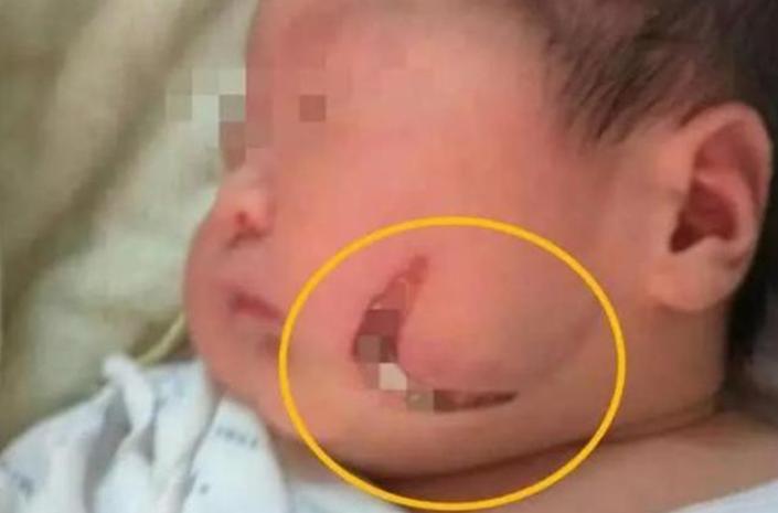 产钳孩子是不是一定有后遗症,产钳夹的印多久可以消失