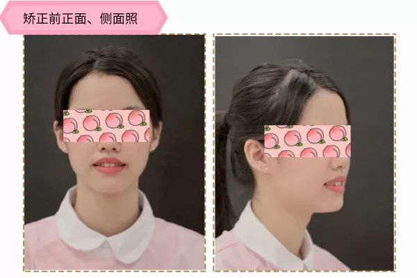 有兔牙如何改善,兔牙怎么矫正