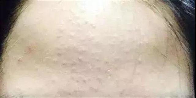 顽固多年黑头闭口毛孔粗大怎么办,南京皮肤病研究所顽固闭口粉刺