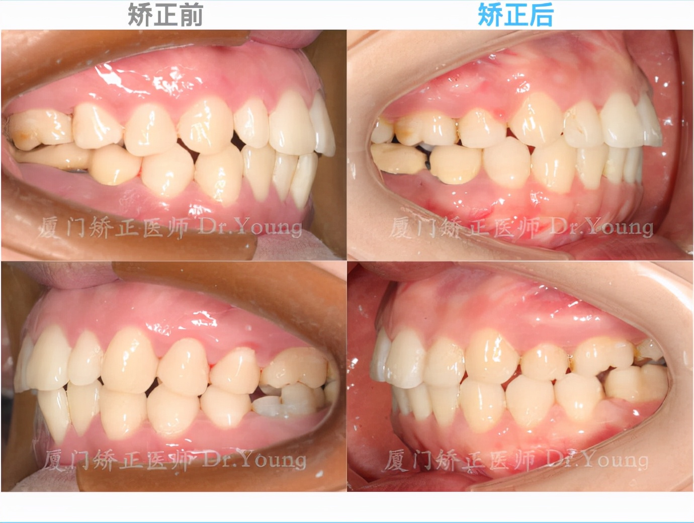 上颌前突下颌后缩是骨性还是牙性,厦门牙齿凸嘴矫正