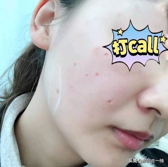 祛痣恢复全过程图片,帅哥祛痣完美蜕变