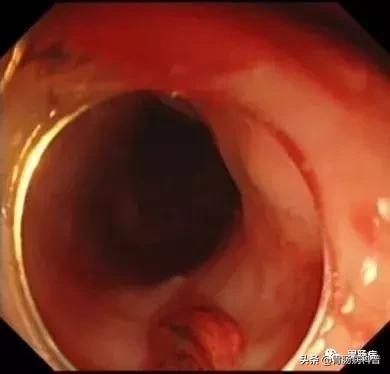 乱吃药伤肝了怎么办,吃药导致出血不止怎么处理