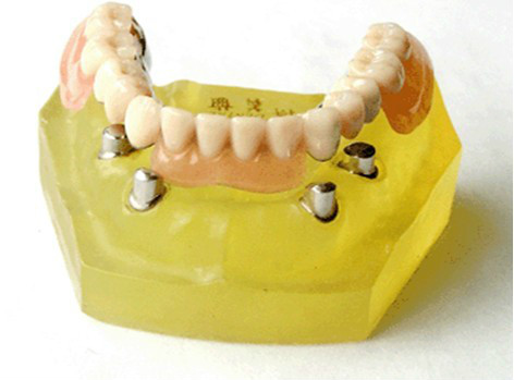 假牙最便宜一颗多少钱,假牙最贵