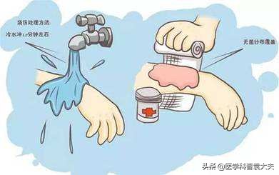 烧伤、烫伤了后如何急救，用冷水冲也讲究学问