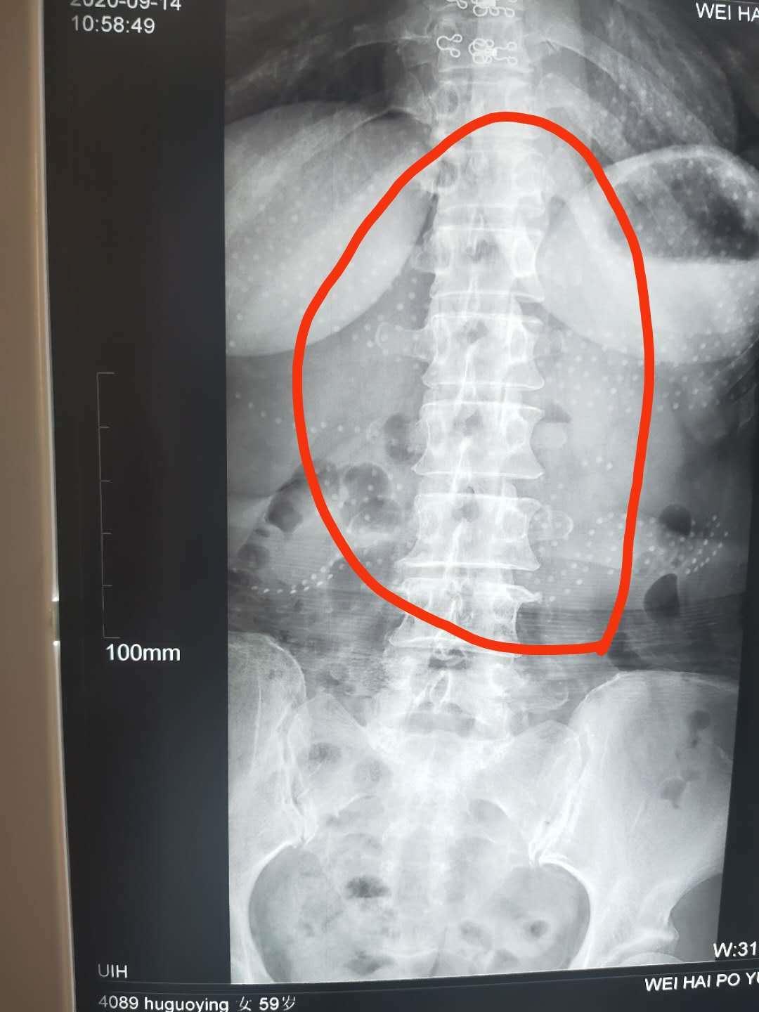 腰痛无法直腰怎么治疗,你还在被疾病困扰吗