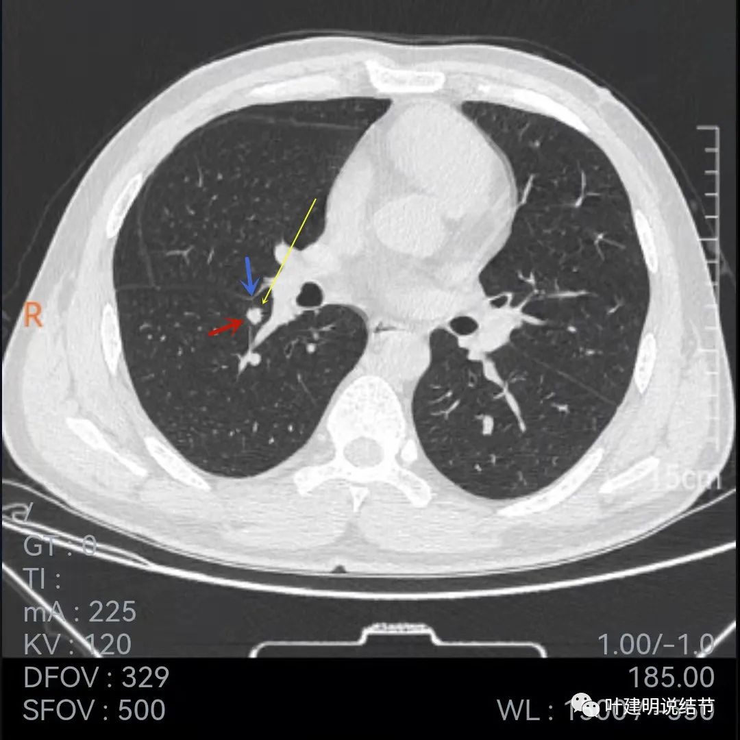 问诊分析:存在了4年的实性结节会不会是肺癌?