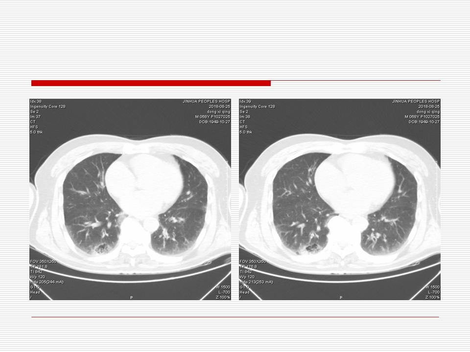 像炎症的肺癌能治好吗,医生说可能是肺癌也可能是炎症