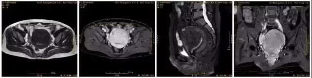 专家讲治疗子宫肌瘤的方法,微创介入子宫肌瘤栓塞术