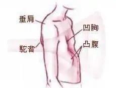 漏斗胸手术后变沟状胸,胸部饱满手术